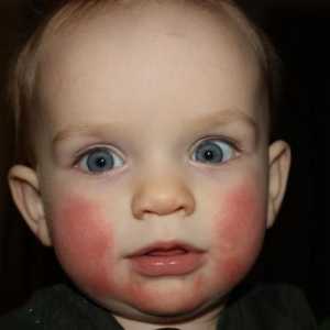 Červené tváře u kojenců: co dělat? Červené tváře u kojenců: příčiny, léčba