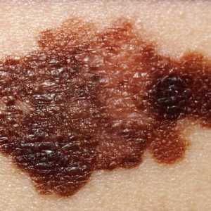 Léčba melanomu: základní techniky