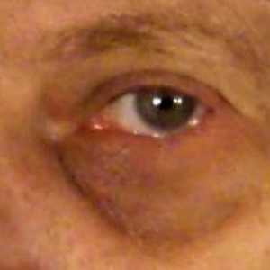 Léčba modřinu pod okem, a populární medicínské metody