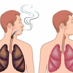 Existuje lék rozedma plic? Příčiny a symptomy