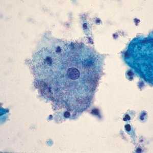 Porušení mikroflóry pochvy: Příčiny a symptomy