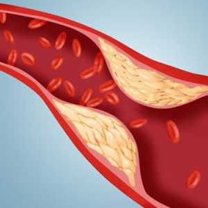 Norma cholesterolu v krvi mužů. Ukazatele hladiny cholesterolu v krvi