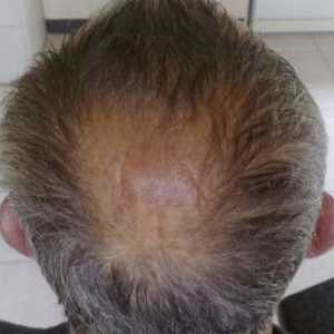 Mužské plešatosti, příčiny a způsoby léčení