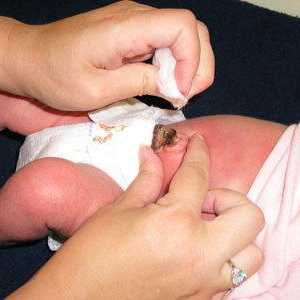 Léčba novorozence pupeční rány: to, co je potřeba a co je postup