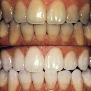 Bělení zubů: typy postupů a vlastností svého chování