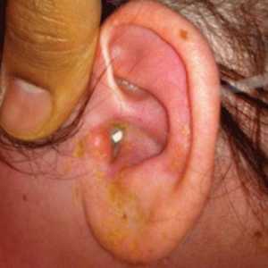 Zánět středního ucha ucho: léčba, příznaky a příčiny