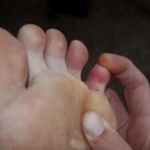 Zlomenina malíčku na noze: První pomoc