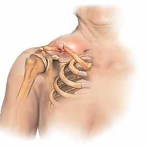 Klíční kost fraktura: příčiny, rysy, léčba