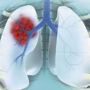 Rakovina plic periferní: stadium, léčba, anamnéza. Periferní plicní podíl rakoviny