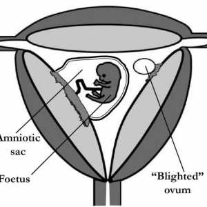 Vajíčko bez embrya. Může se oplodněné vajíčko je bez embrya?
