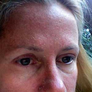 Proč šupinatá kůže na obličeji? Příčiny a léčba