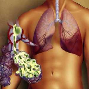 Pravostranné zápal plic: příčiny, příznaky a léčba