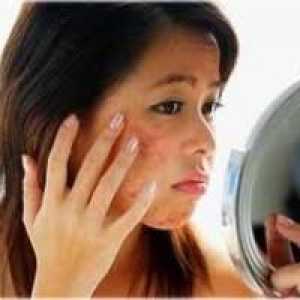 Příčiny akné na obličeji a jak se jich zbavit
