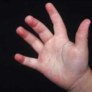 Příznakem jakékoli nemoci je vyrážka v dítěte nohy a ruce