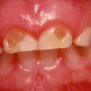 Prevence a léčba zubního kazu u dětí