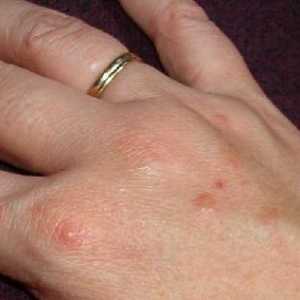 Pupínky na rukou - příčiny a léčba