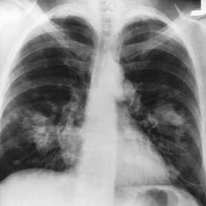 Lung Cancer: Kolik žije? Měl jsem věřit předpovědi?