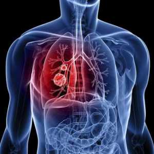 Spinocelulární karcinom plic: popis, příčiny, diagnostika a léčba rysy