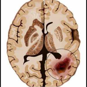 Rakovina mozku: příčiny, příznaky a diagnostika