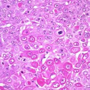 Dlaždicobuněčný karcinom děložního hrdla: prognóza, léčba