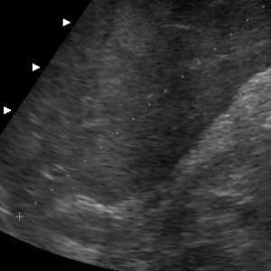 Rozměry normální jaterní ultrazvuku (přepis)