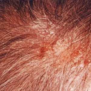 Seboroická dermatitida na hlavě: léčba a klinický obraz