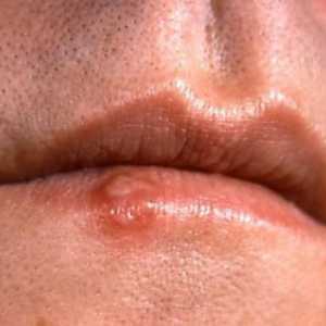 Příznaky rakoviny úst - jak je rozpoznat?