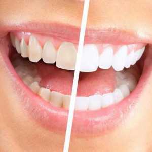 Teeth Whitening System Global White: recenze. Globální Bílá: klady a zápory