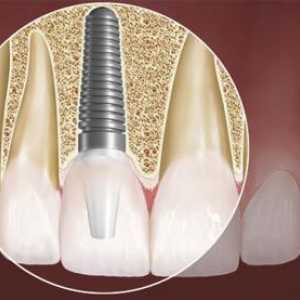 Kolik je vložit zuby? Dentální implantáty - alternativní způsob, jak se vrátit do své bývalé krásy…
