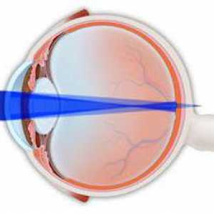 Sloučenina myopický astigmatismus do obou očí u dětí: Léčba