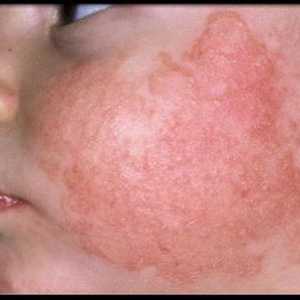 Solární dermatitida (fotodermatóza)