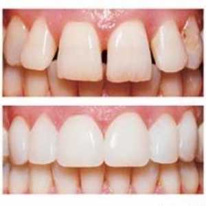 Moderní dýhy na zuby: to, co je
