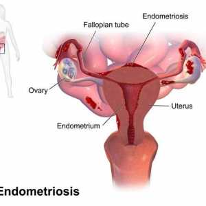 Spirální „Mirena“ Endometrióza: recenze
