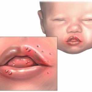 Stomatitida u kojenců: léčba a prevence