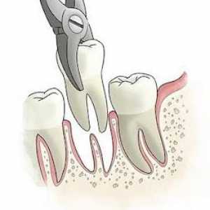 Vyjmutí kořene zubu - složité, ale nejvíce bezbolestný postup