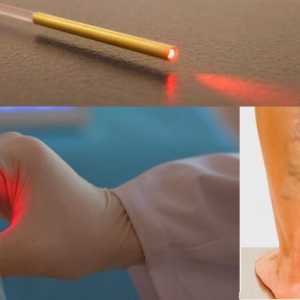 Žíly laserové odstranění: recenze, důsledky a rehabilitace