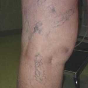 Viditelné žilky v nohách - příčinou křečových žil?