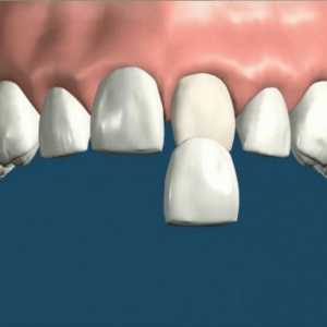 Dýha na zuby výhody prvku rysy jeho instalaci a indikace pro použití