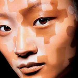 Vitiligo - co je to? Příčiny, příznaky a léčba vitiligo