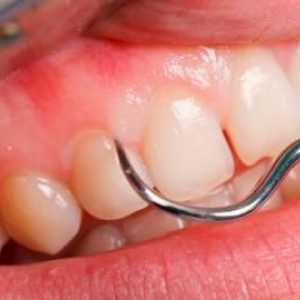 Zánět dásní okolo zubů moudrosti. Jako doma odstranit zánět dásní