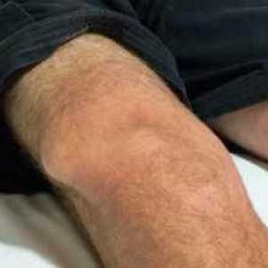 Dislokace kolenního kloubu: hlavní příznaky, léčba
