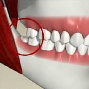 Zub moudrosti: zda se má odstranit „Skupina osmi“, který bolí?